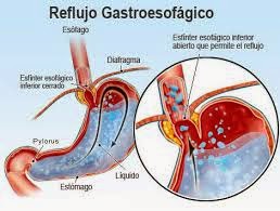 reflujo gastro esofagico